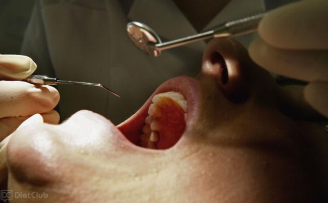 むし歯治療のイメージ　写真提供：Getty Images
